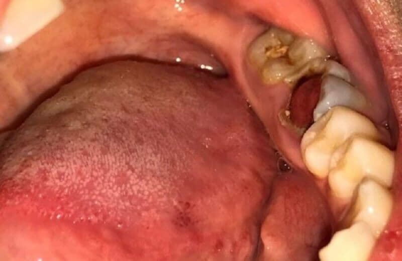 Răng sâu lồi thịt biểu thị tình trạng sâu răng khá nặng.