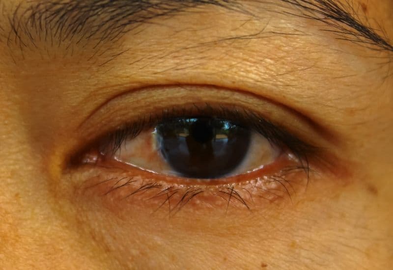 Mộng thịt là bệnh lý nhãn khoa mà trong đó, mô liên kết và màng nhầy trên bề mặt mắt phát triển bất thường.