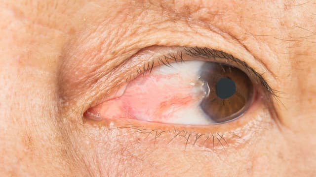 Chi tiết về chi phí phẫu thuật mộng thịt ở mắt