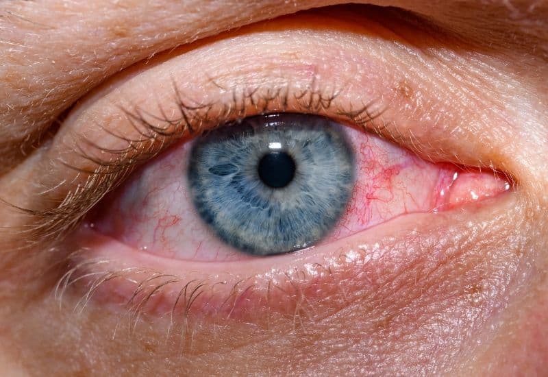 Có hạt trong mắt là tình trạng phổ biến, thường đi kèm một số vấn đề khác như đỏ mắt, ngứa mắt, chảy nước mắt, nhạy cảm với ánh sáng và suy giảm thị lực.