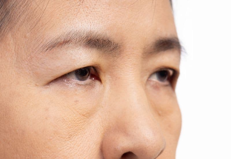 Yếu cơ mi mắt hay yếu cơ nâng mí là một vấn đề phổ biến của cơ mi mắt; vấn đề này có thể dẫn đến tình trạng sụp mí - tình trạng mí mắt trên sụp xuống, che khuất một phần hoặc toàn bộ con ngươi, gây cản trở tầm nhìn.