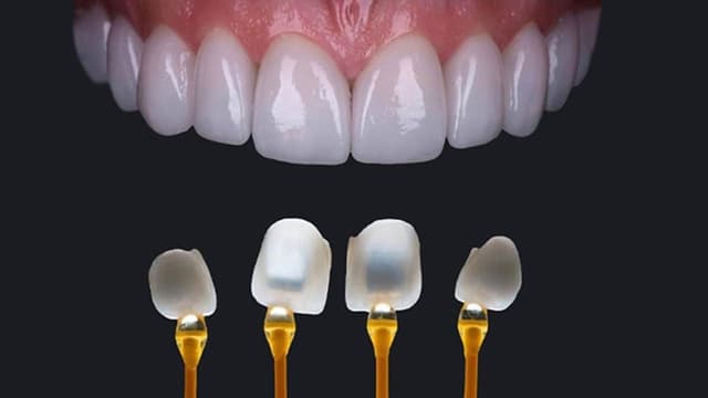 Dán sứ veneer bao nhiêu tiền và những điều cần biết