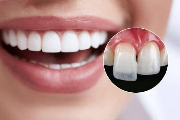 Dán sứ có thể khắc phục nhiều khuyết điểm của răng.