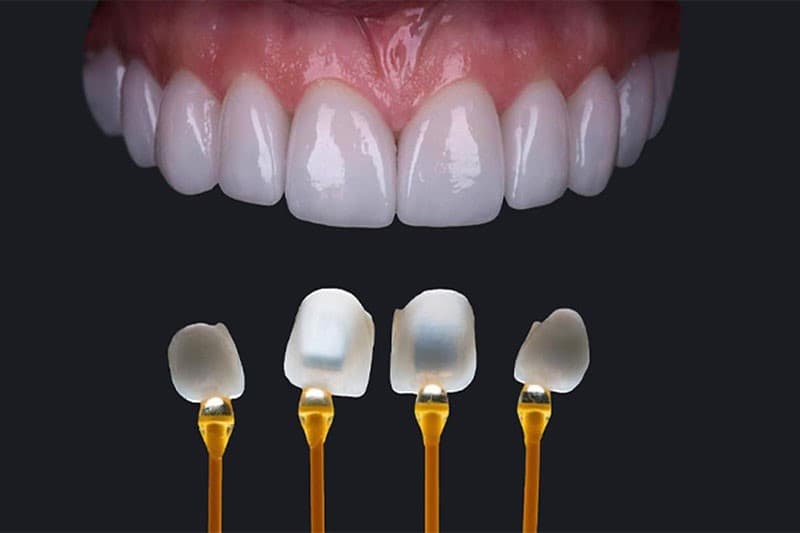 Có nhiều yếu tố ảnh hưởng đến chi phí dán sứ.