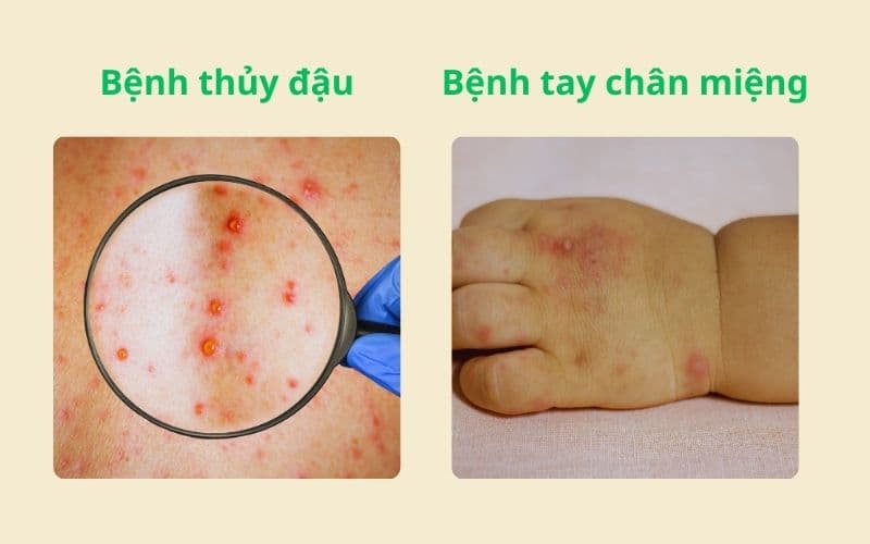 Dấu hiệu bệnh thủy đậu và tay chân miệng không hoàn toàn giống nhau
