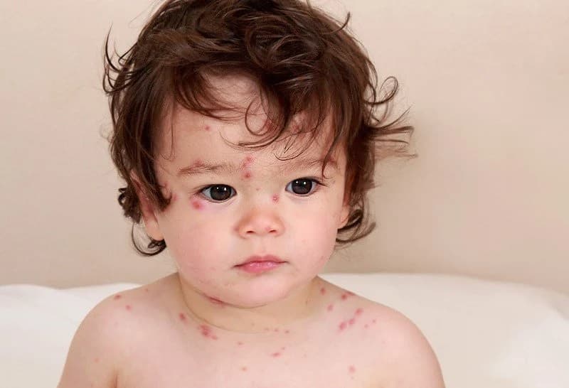 Dấu hiệu bị thủy đậu điển hình trên da của trẻ là mụn nước