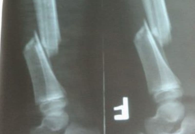 hình ảnh gãy xương cẳng chân