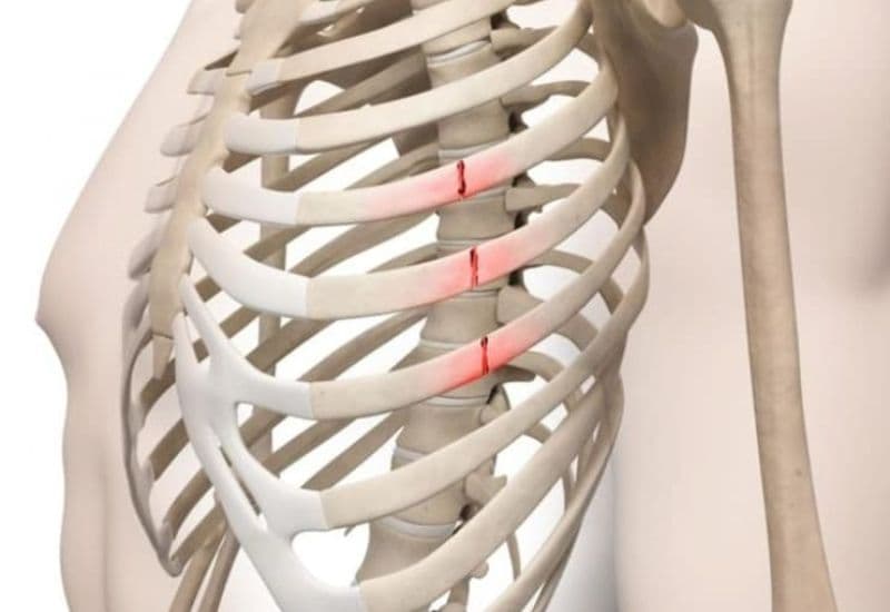 gãy xương sườn