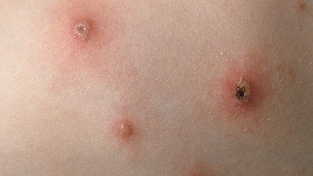 Dấu hiệu khởi bệnh thủy đậu: Bội nhiễm và biến chứng