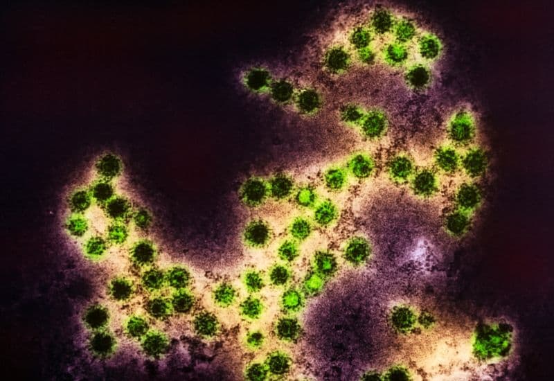 Đau mắt đỏ chỉ là viêm kết mạc do virus.