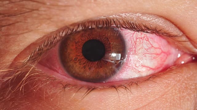 Đau mắt đỏ: Từ triệu chứng đến điều trị