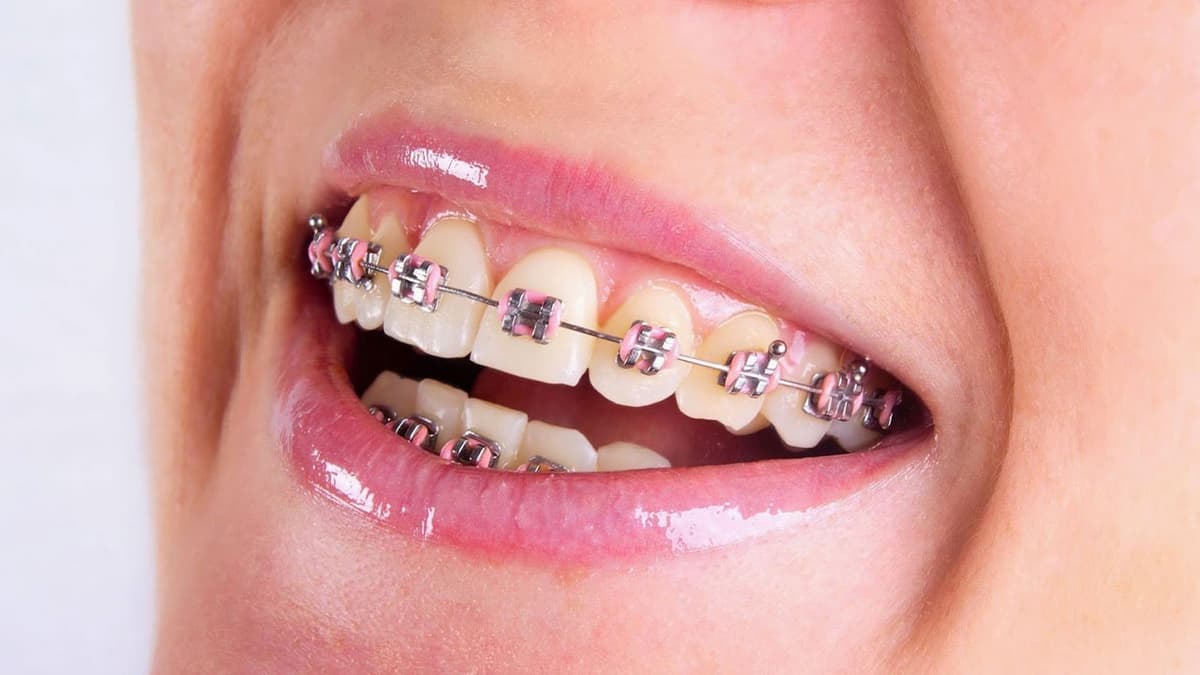 Cách xác định địa chỉ niềng răng uy tín