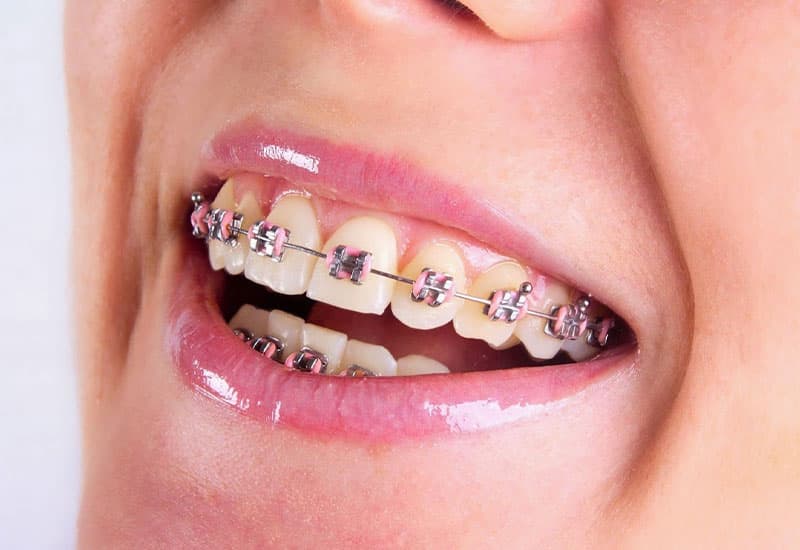 tư vấn địa chỉ niềng răng uy tín 