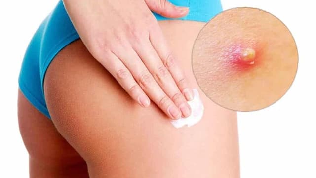Áp xe mông: nguyên nhân, triệu chứng và điều trị