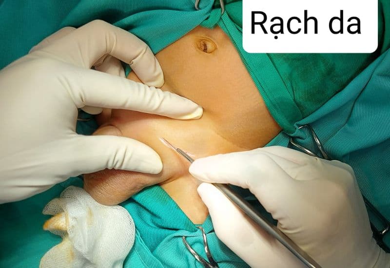 mổ mở điều trị thoát vị bẹn