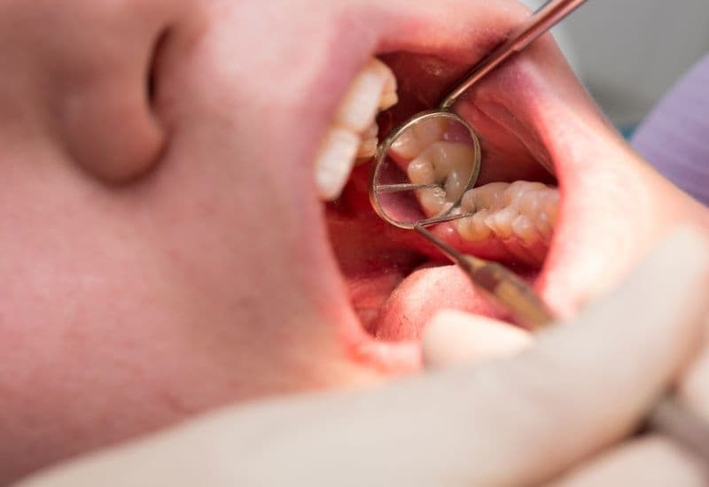 Sâu răng là nguyên nhân phổ biến nhất gây tổn thương tủy răng.