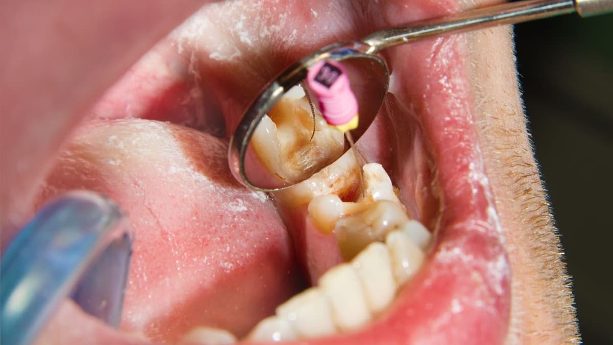 Điều trị tủy răng giá bao nhiêu, giải đáp chi tiết thắc mắc