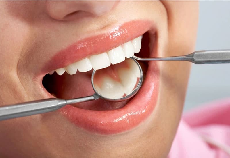 Dụng cụ lấy cao răng đắt không ?