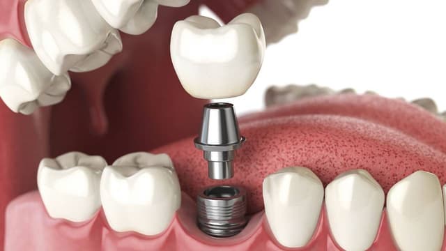 Giá cấy ghép Implant &#8211; Cập nhật chi tiết