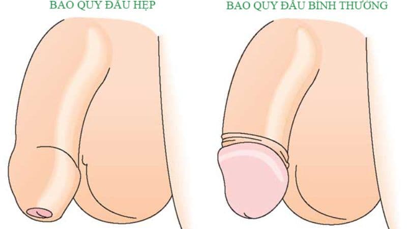 hẹp bao quy đầu ở người lớn