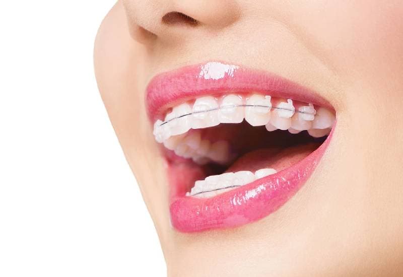 kết quả hình ảnh niềng răng 