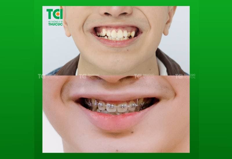 hình ảnh niềng răng chân thực