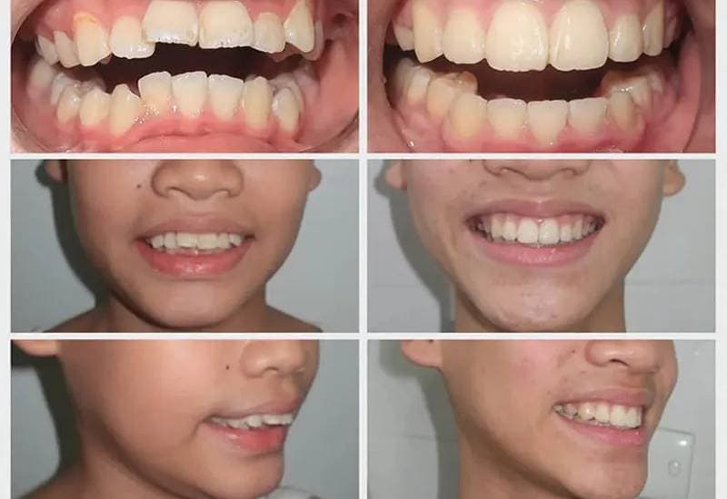 các hình ảnh niềng răng 