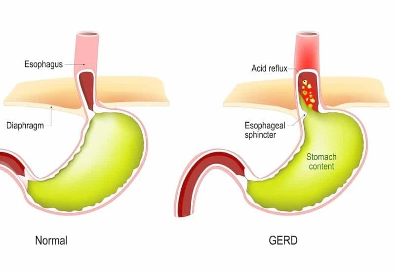 Đánh giá mức độ của GERD khi có biểu hiện ho đờm