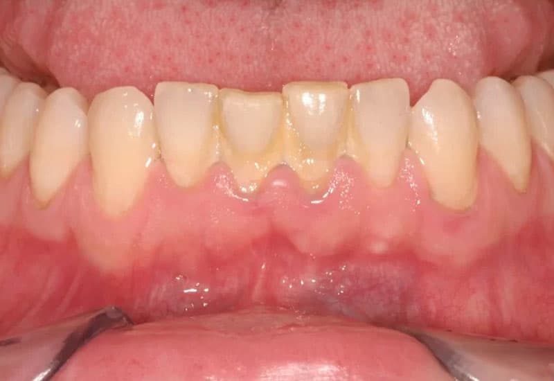 chi phí lấy vôi răng