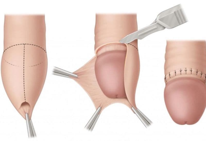 lợi ích cắt bao quy đầu