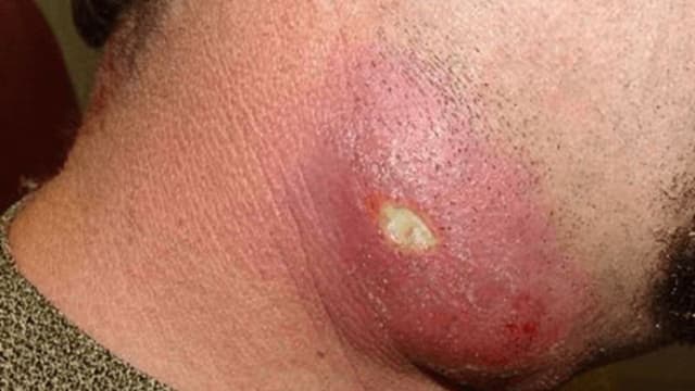 Những biến chứng nguy hiểm khi áp xe tự vỡ