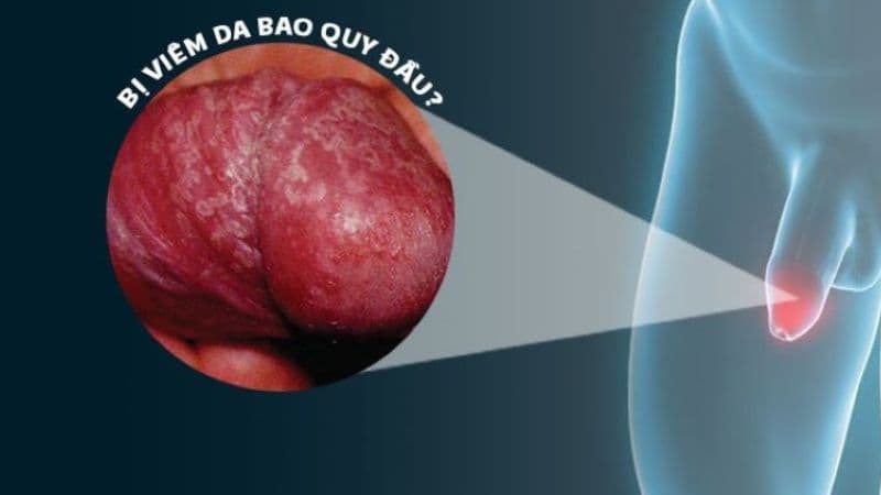 dấu hiệu hẹp bao quy đầu ở người lớn