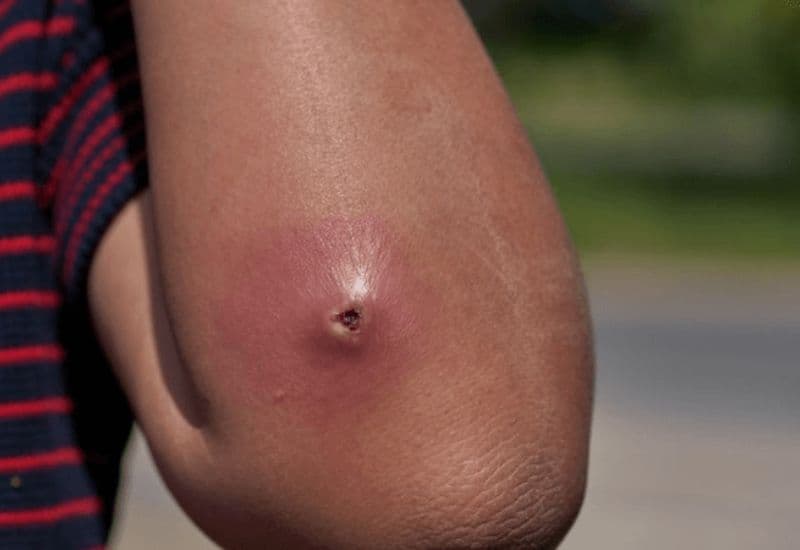 dấu hiệu áp xe cần nhận diện sớm 