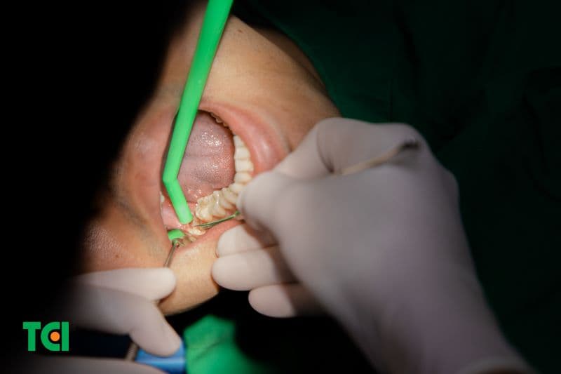 Quy trình nhổ răng cần được thực hiện đúng và đủ để đảm bảo an toàn.