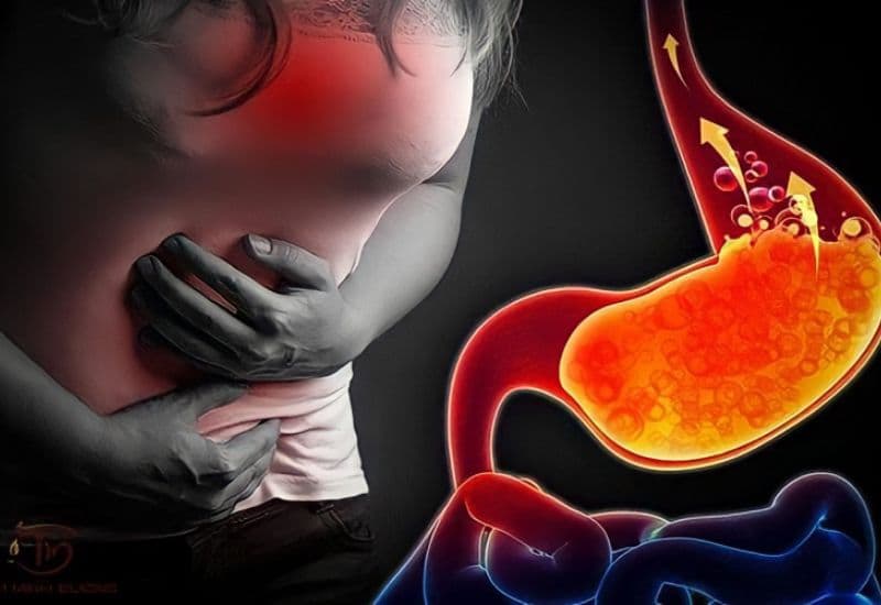 Những triệu chứng của trào ngược dạ dày