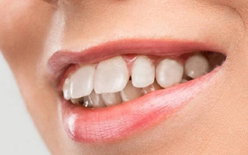 niềng răng hô như thế nào