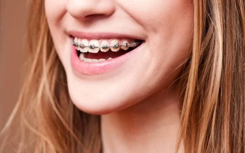 niềng răng hô bằng cách nào