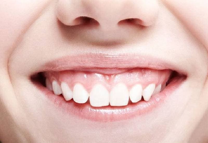 Niềng răng hô hàm trên không