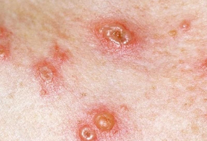 Nốt thủy đậu khô, đóng vảy