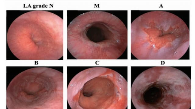 Các phân độ trào ngược dạ dày thực quản và cách điều trị