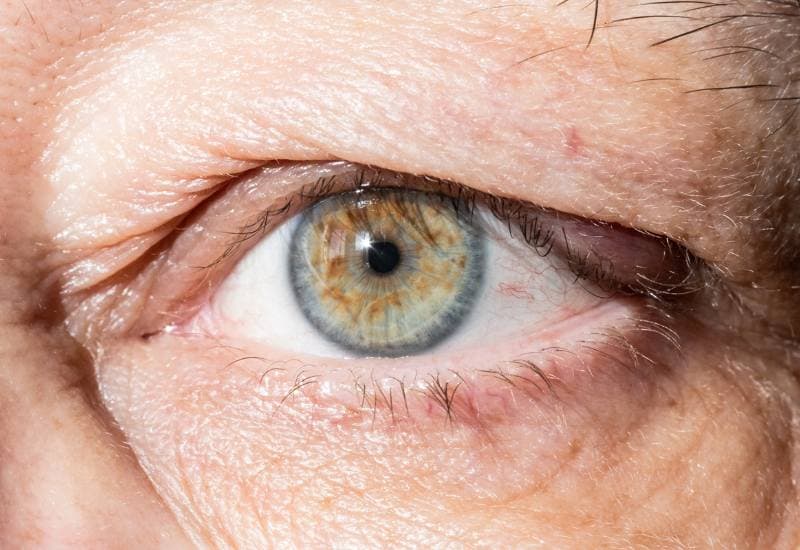 Sụp mí mắt là tình trạng mà trong đó mí mắt trên bị sa xuống thấp hơn bình thường, đôi khi có thể che lấp một phần giác mạc, ảnh hưởng đến tầm nhìn.