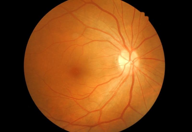 Quét võng mạc là một kỹ thuật chẩn đoán hình ảnh không xâm lấn, cho phép bác sĩ nhãn khoa quan sát và đánh giá chi tiết cấu trúc của võng mạc – lớp mô nhạy cảm với ánh sáng nằm ở phía sau nhãn cầu.