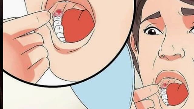 Sưng lợi hàm dưới trong cùng và xử trí đúng cách