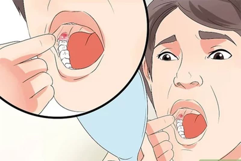 Sưng lợi hàm dưới trong cùng là bị gì