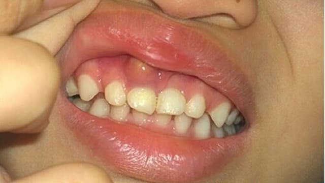 Sưng lợi hàm trên răng cửa và những cảnh báo răng miệng