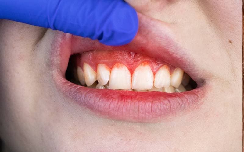 sưng nướu răng cửa hàm trên do đâu