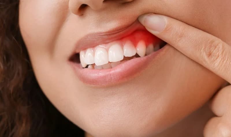 Thuốc bôi trị viêm nướu răng là loại nào