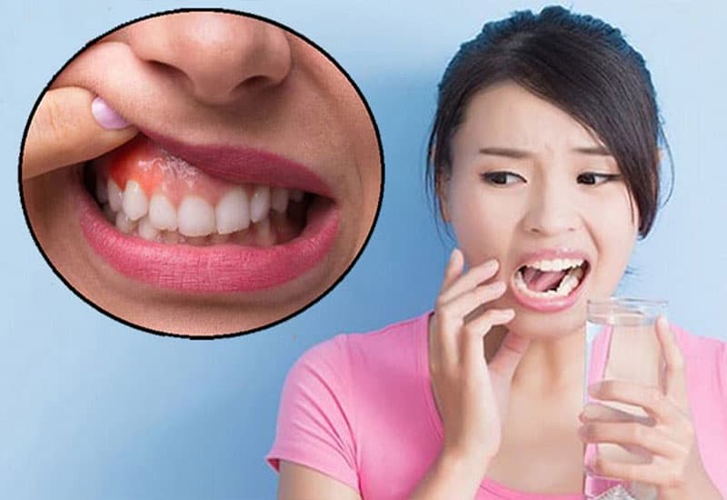 Sử dụng thuốc chấm chân răng như thế nào 