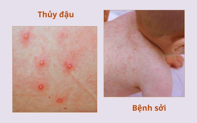 Triệu chứng thủy đậu và sởi không hoàn toàn giống nhau