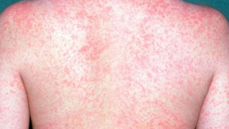 Cũng giống như thủy đậu, hiện tại chúng ta chỉ có thể điều trị triệu chứng bệnh sởi